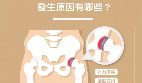 淺談「髖關節唇破裂」