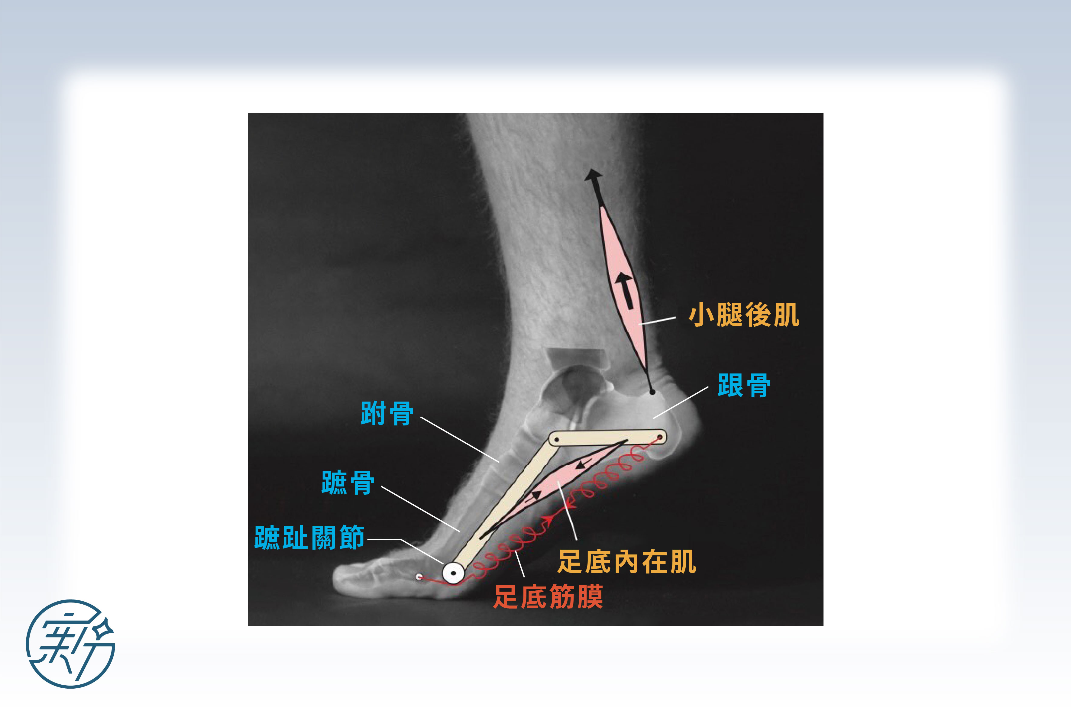 恆新健康網| 【足部】足底筋膜炎plantar fasciitis